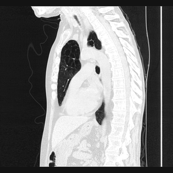 Centrilobular pulmonary emphysema (Radiopaedia 24495-24789 Sagittal lung window 46).jpg