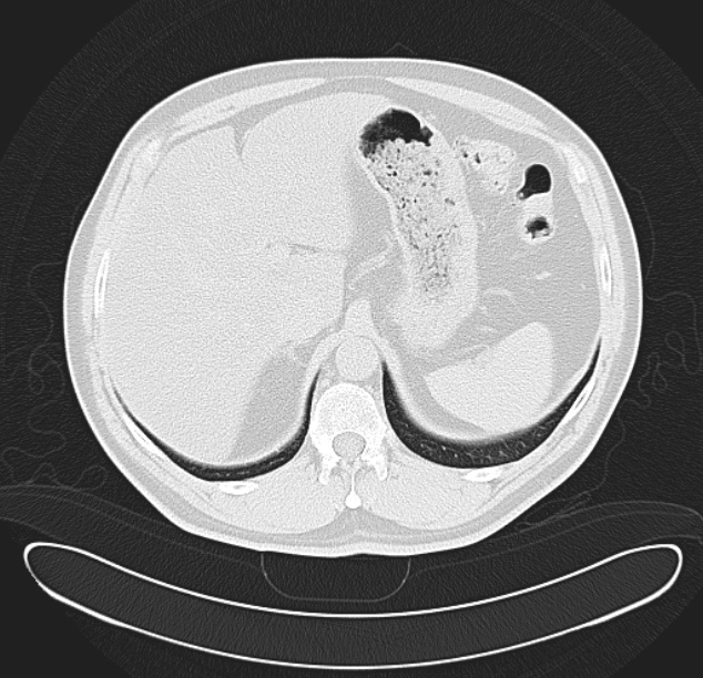 Centrilobular pulmonary emphysema (Radiopaedia 26808-26971 C 43).jpg