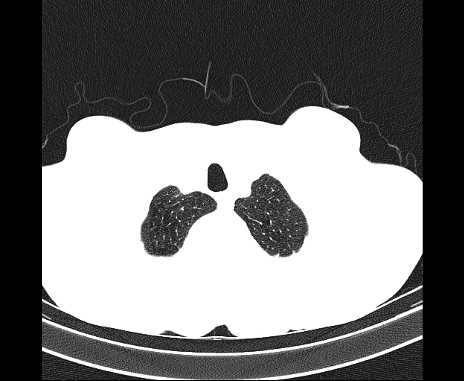Centrilobular pulmonary emphysema (Radiopaedia 62468-70718 Axial lung window 5).jpg