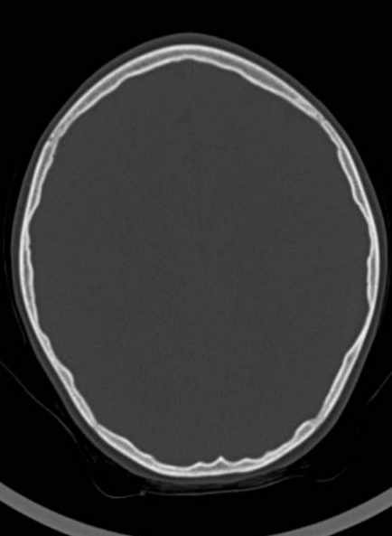 Cerebellar abscess (Radiopaedia 73727-84527 Axial bone window 45).jpg