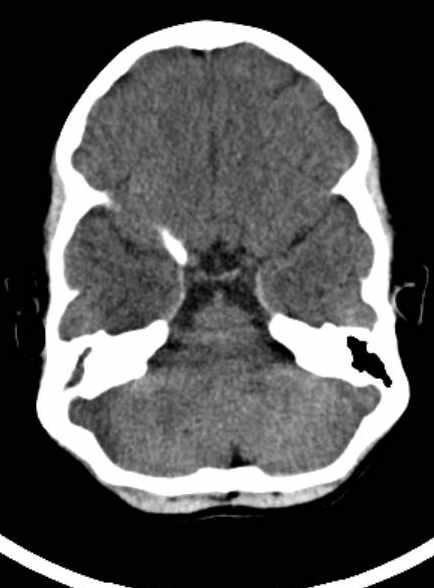 File:Cerebellar abscess (Radiopaedia 73727-84527 Axial non-contrast 28).jpg