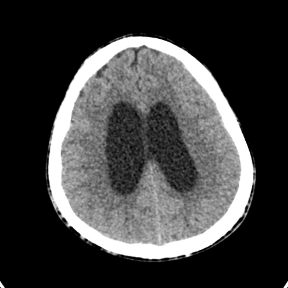 Cerebellar abscess secondary to mastoiditis (Radiopaedia 26284-26412 Axial non-contrast 113).jpg