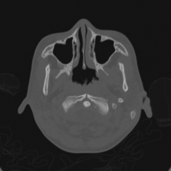 Cerebellar abscess secondary to mastoiditis (Radiopaedia 26284-26413 Axial bone window 9).jpg