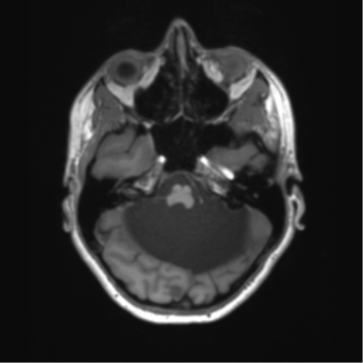 Cerebellar agenesis with hypoplastic pons (pontocerebellar hypoplasia) (Radiopaedia 57224-64138 Axial T1 22).png