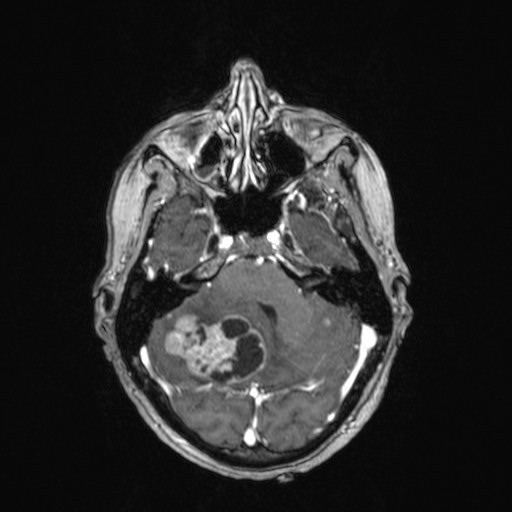Cerebellar metastases (Radiopaedia 24038-24249 Axial T1 C+ 37).jpg