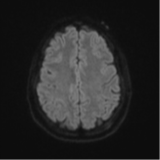 Cerebellar metastasis (Radiopaedia 51137-56765 Axial DWI 49).png