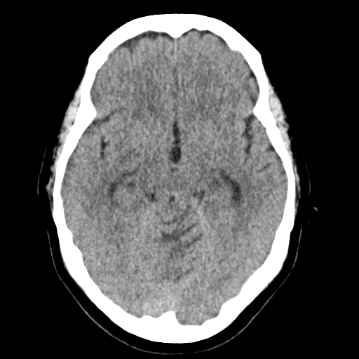 File:Cerebellar metastasis (Radiopaedia 54578-60812 Axial non-contrast 20).png