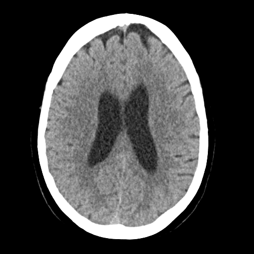 Cerebellar metastasis (Radiopaedia 54578-60812 Axial non-contrast 31).png