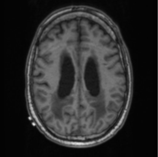 Cerebellar metastasis from lung adenocarcinoma (Radiopaedia 86690-102829 Axial T1 55).png