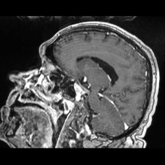 Cerebellar metastasis of pulmonary adenocarcinoma, cavernous venous malformation, and developmental venous anomaly (Radiopaedia 85827-101661 Sagittal T1 C+ 57).jpg