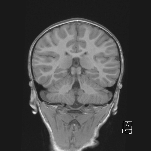 Cerebellar stroke (Radiopaedia 32202-33150 Coronal T1 38).png
