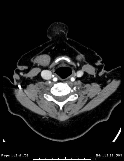 Cerebellar strokes due to intracranial giant cell arteritis (Radiopaedia 68799-78510 CT angiogram 112).jpg