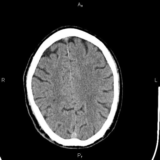 Cerebellopontine angle arachnoid cyst (Radiopaedia 85149-100704 Axial With contrast 36).jpg
