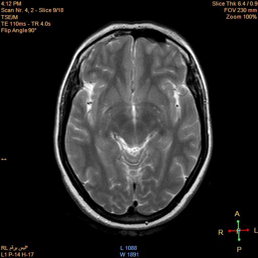 File:Cerebellopontine angle meningioma (Radiopaedia 22488-22525 Axial T2 7).jpg