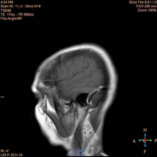 File:Cerebellopontine angle meningioma (Radiopaedia 22488-22525 Sagittal T1 C+ 2).jpg