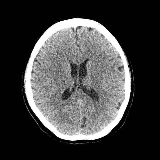 Cerebellopontine angle meningioma (Radiopaedia 53561-59592 Axial non-contrast 40).jpg