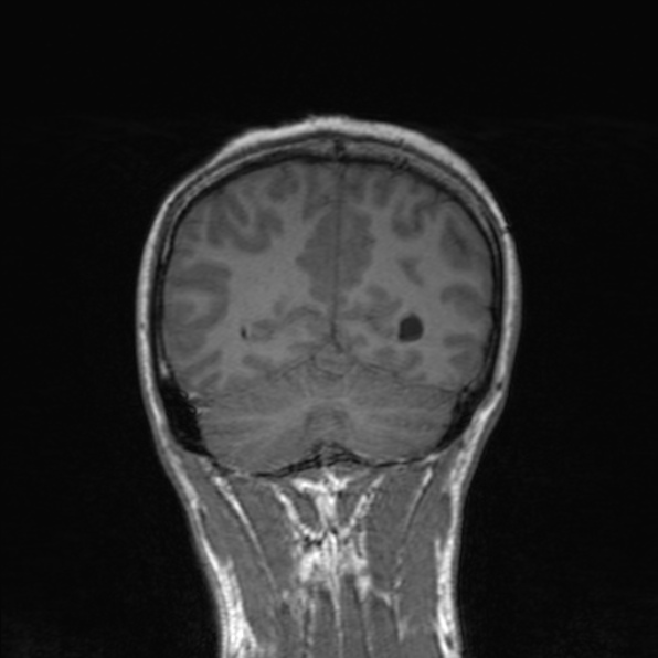 Cerebral abscess (Radiopaedia 24212-24478 Coronal T1 157).jpg