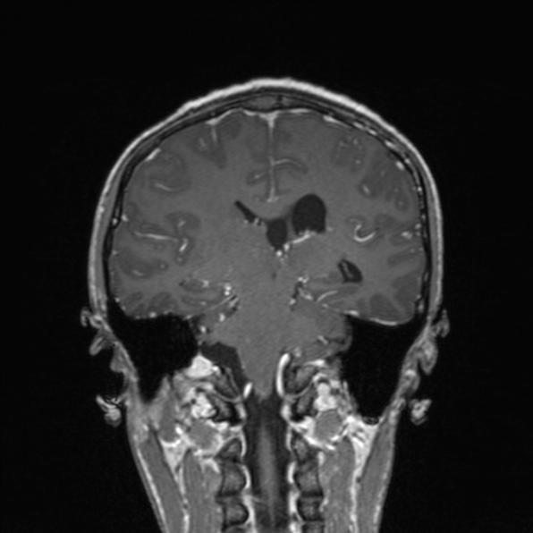 Cerebral abscess (Radiopaedia 24212-24478 Coronal T1 C+ 128).jpg