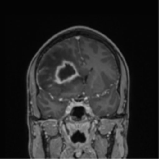 File:Cerebral abscess (Radiopaedia 60342-68009 H 32).png