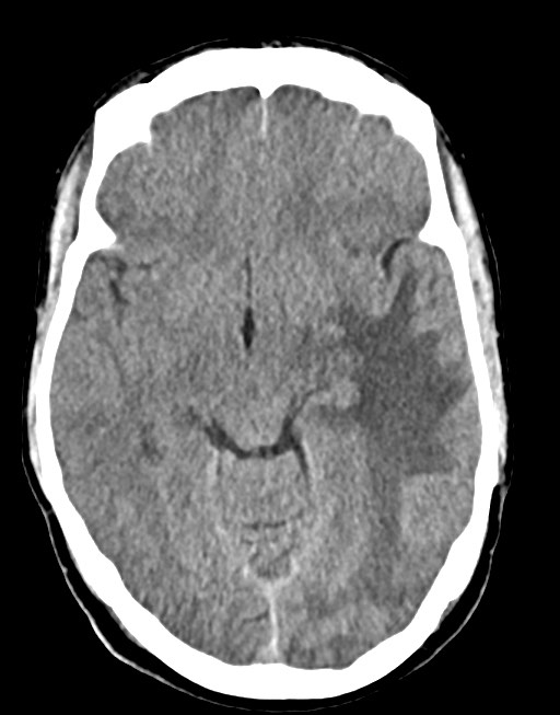 Cerebral abscesses (Radiopaedia 70458-80568 Axial non-contrast 28).jpg