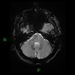 File:Cerebral amyloid angiopathy-associated lobar intracerebral hemorrhage (Radiopaedia 58376-65512 Axial Gradient Echo 20).jpg