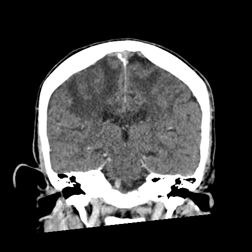 File:Cerebral amyloid angiopathy-related inflammation (Radiopaedia 74836-85848 Coronal non-contrast 41).jpg