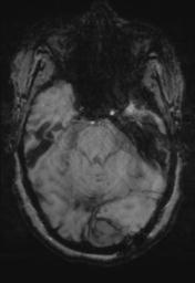 File:Cerebral amyloid angiopathy (Radiopaedia 29129-29518 Axial SWI Magnitude 10).jpg