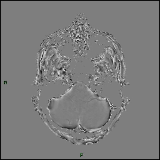 Cerebral amyloid angiopathy (Radiopaedia 77506-89664 H 24).jpg