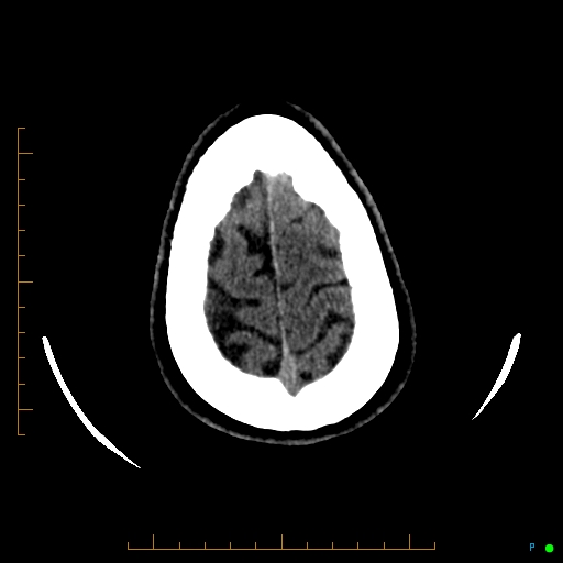Cerebral arteriovenous malformation (AVM) (Radiopaedia 78162-90706 Axial non-contrast 58).jpg