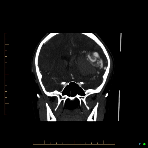 Cerebral arteriovenous malformation (AVM) (Radiopaedia 78162-90706 Coronal CTA 65).jpg