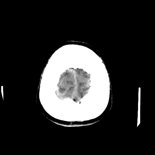 Cerebral arteriovenous malformation (Radiopaedia 28518-28759 Axial non-contrast 68).jpg