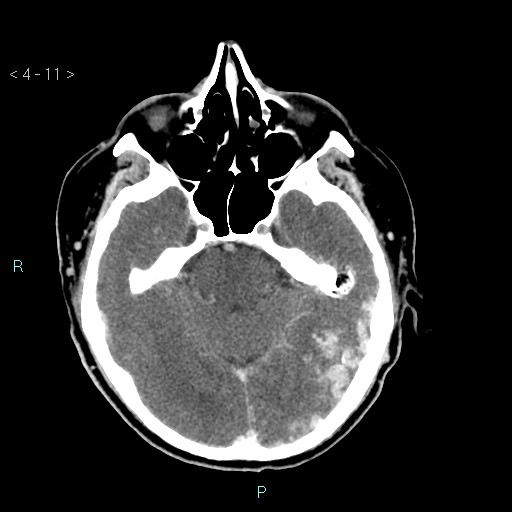 File:Cerebral arteriovenous malformation (Radiopaedia 40528-43125 Axial C+ delayed 11).jpg