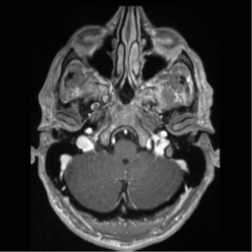 Cerebral arteriovenous malformation (Radiopaedia 55798-62372 Axial T1 C+ 12).png