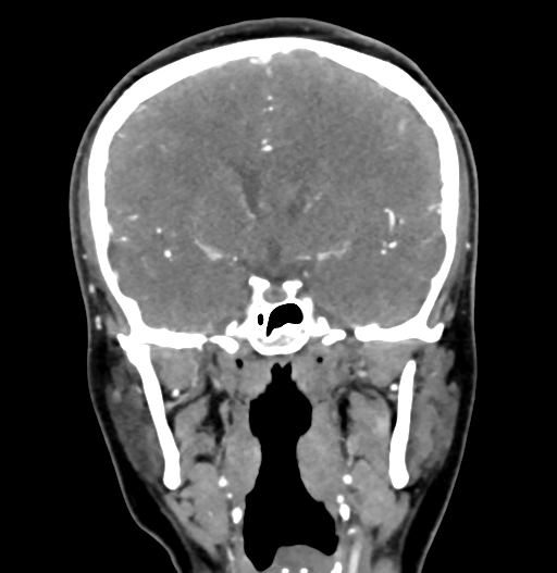 Cerebral arteriovenous malformation (Radiopaedia 73830-84645 C 46).jpg