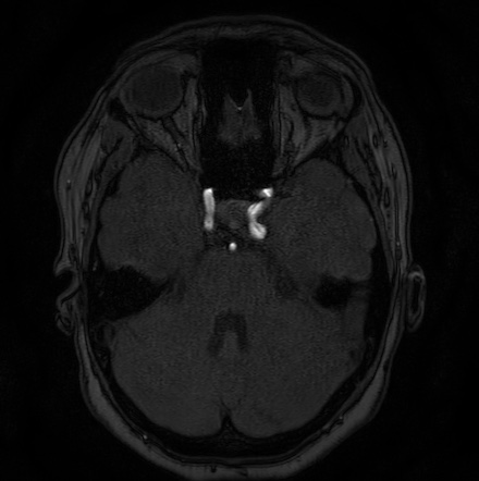 Cerebral arteriovenous malformation (Radiopaedia 74411-85654 Axial MRA 31).jpg