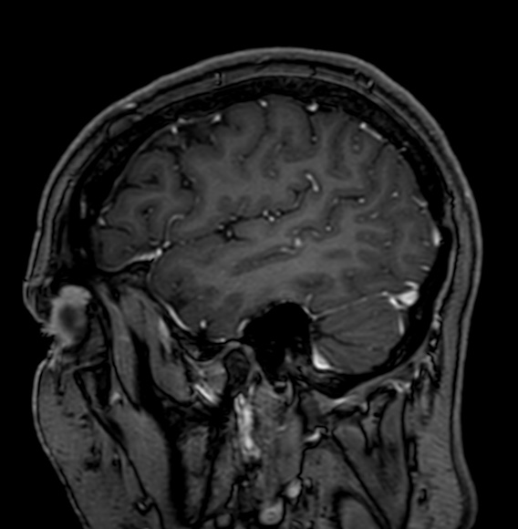 Cerebral arteriovenous malformation (Radiopaedia 74411-85746 Sagittal T1 C+ 20).jpg