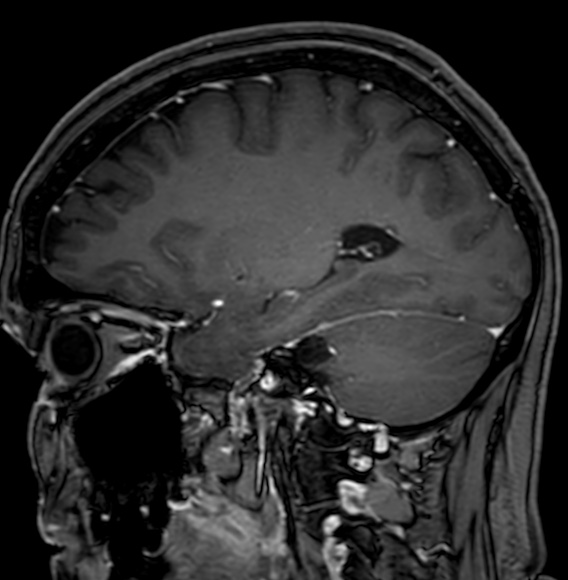 Cerebral arteriovenous malformation (Radiopaedia 74411-85746 Sagittal T1 C+ 41).jpg
