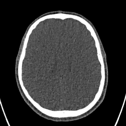 Cerebral arteriovenous malformation (Radiopaedia 78188-90746 Axial non-contrast 114).jpg