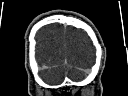Cerebral arteriovenous malformation (Radiopaedia 78188-90746 Coronal C+ delayed 113).jpg