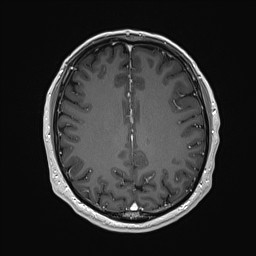 Cerebral arteriovenous malformation (Radiopaedia 84015-99245 Axial T1 C+ 105).jpg