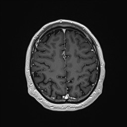 Cerebral arteriovenous malformation (Radiopaedia 84015-99245 Axial T1 C+ 122).jpg