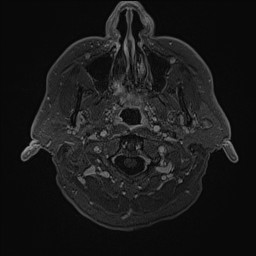 Cerebral arteriovenous malformation (Radiopaedia 84015-99245 Axial T1 C+ 9).jpg
