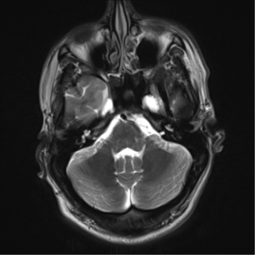 File:Cerebral arteriovenous malformation - huge (Radiopaedia 35734-37272 Axial T2 5).png
