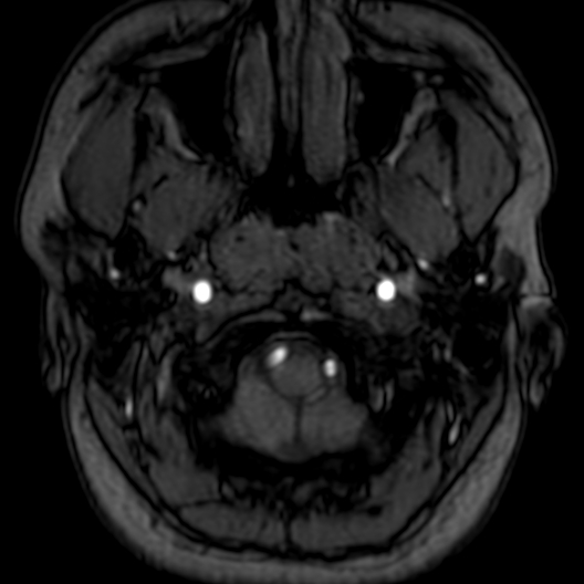 Cerebral arteriovenous malformation at posterior body of corpus callosum (Radiopaedia 74111-84925 Axial MRA 2).jpg
