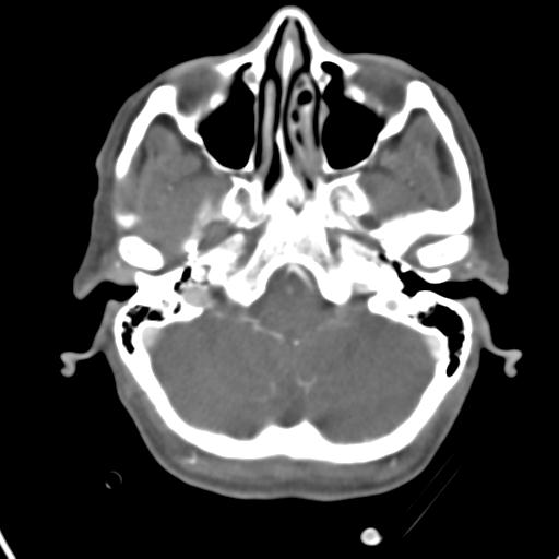 Cerebral arteriovenous malformation with hemorrhage (Radiopaedia 28773-29073 A 44).jpg