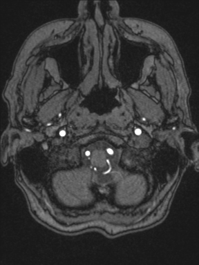 Cerebral arteriovenous malformation with hemorrhage (Radiopaedia 34422-35737 Axial MRA 5).png