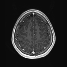 File:Cerebral cavernous venous malformation (Radiopaedia 70008-80021 Axial T1 C+ 81).jpg