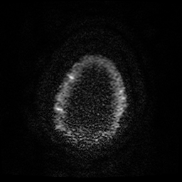 File:Cerebral cavernous venous malformation (Zabramski type II) (Radiopaedia 85511-101198 Axial DWI 31).jpg