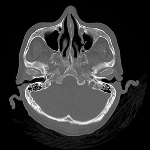 Cerebral contusions, subarachnoid hemorrhage and subdural hygromas (Radiopaedia 55399-61827 Axial bone window 11).png