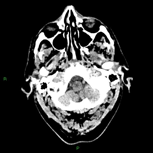 Cerebral contusions (Radiopaedia 33868-35039 Axial non-contrast 19).jpg